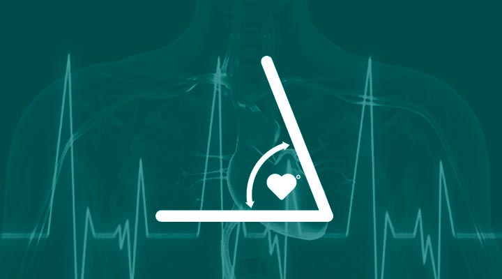 Hospital SOS Cárdio - O Teste de Inclinação, chamado Tilt Test, é um exame  complementar utilizado para diagnosticar a causa e definir o tratamento de  pacientes com sintomas de tonturas e/ou desmaios.